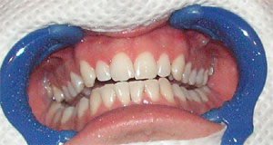 Smile makeover after treatment