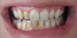 Smile makeover case before treatment